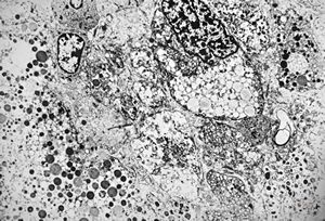 M,58y. | retroperitoneal liposarcoma